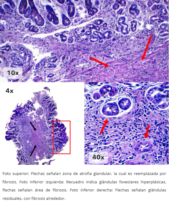 Atrofia Glandular