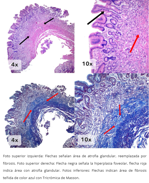 Atrofia Glandular