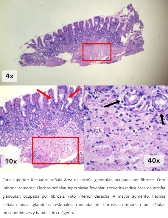 Atrofia Glandular