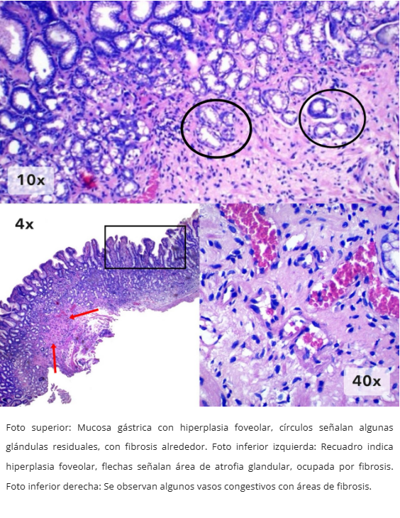 Atrofia Glandular