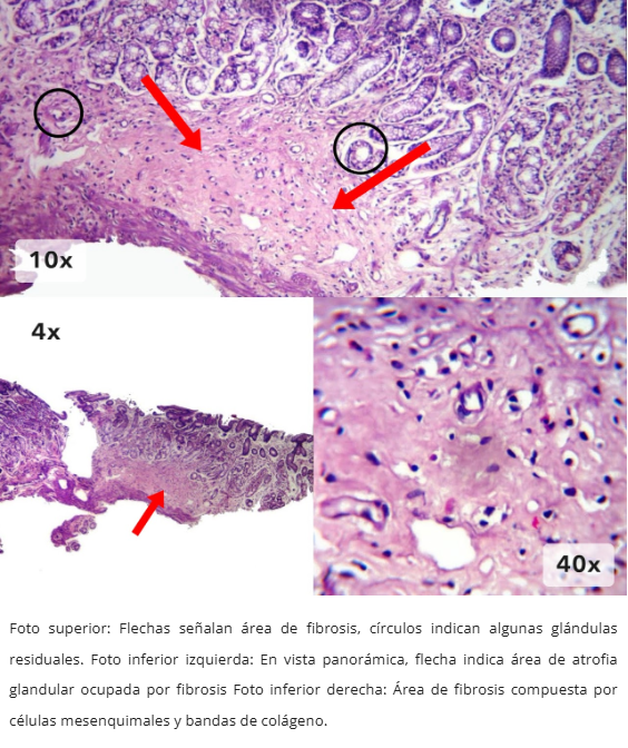 Atrofia Glandular
