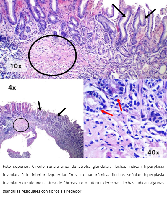 Atrofia Glandular