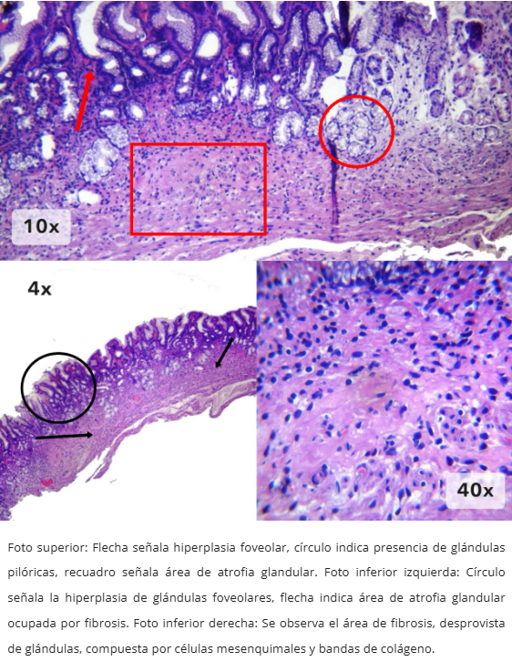 Atrofia Glandular