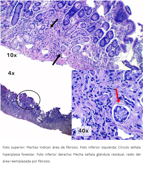 Atrofia Glandular