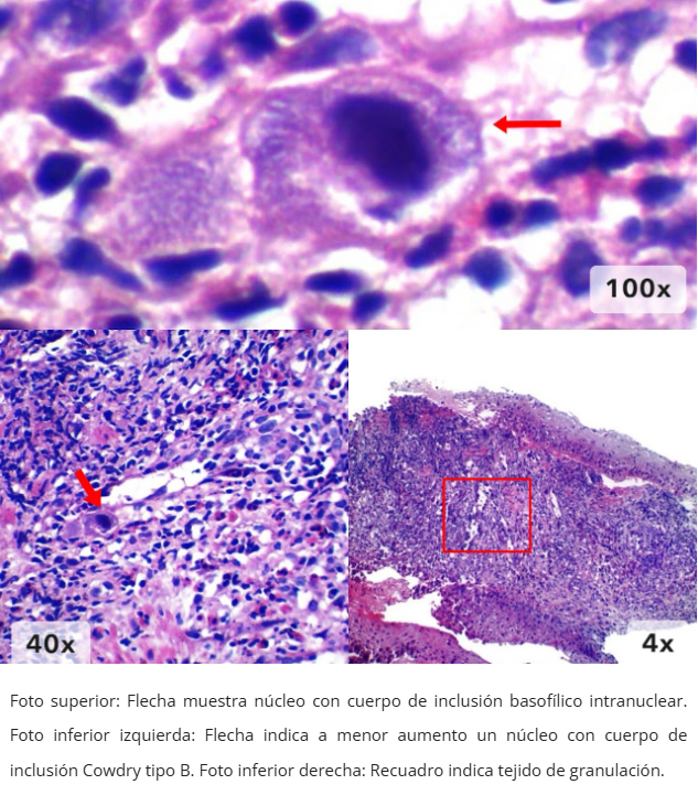 Esofagitis por CMV