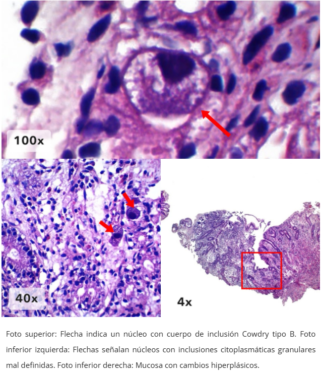 Esofagitis por CMV