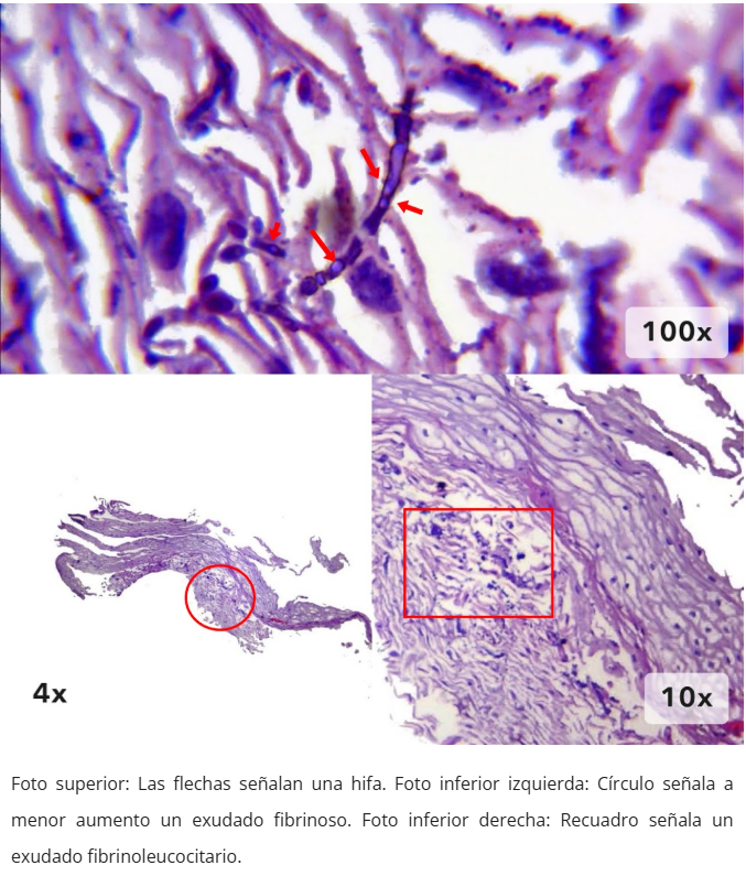 Esofagitis candidiásica
