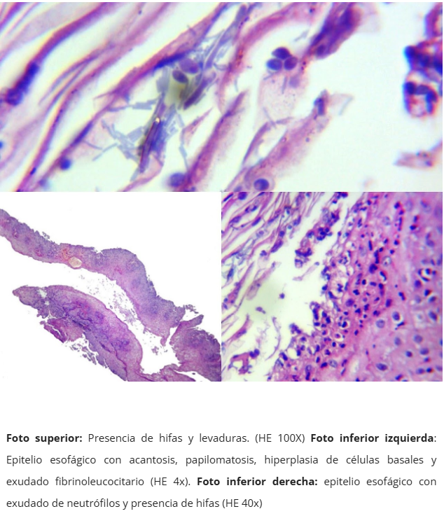 Esofagitis candidiásica