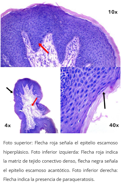 Imagen microscópica de pólipo fibroepitelial