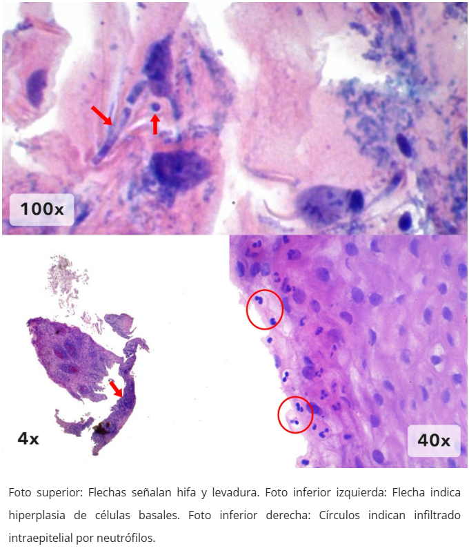 Esofagitis candidiásica