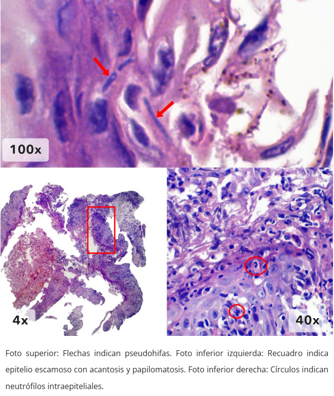 Esofagitis candidiásica