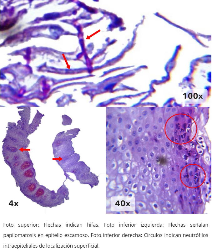 Esofagitis candidiásica
