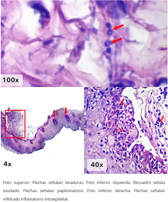 Esofagitis candidiásica