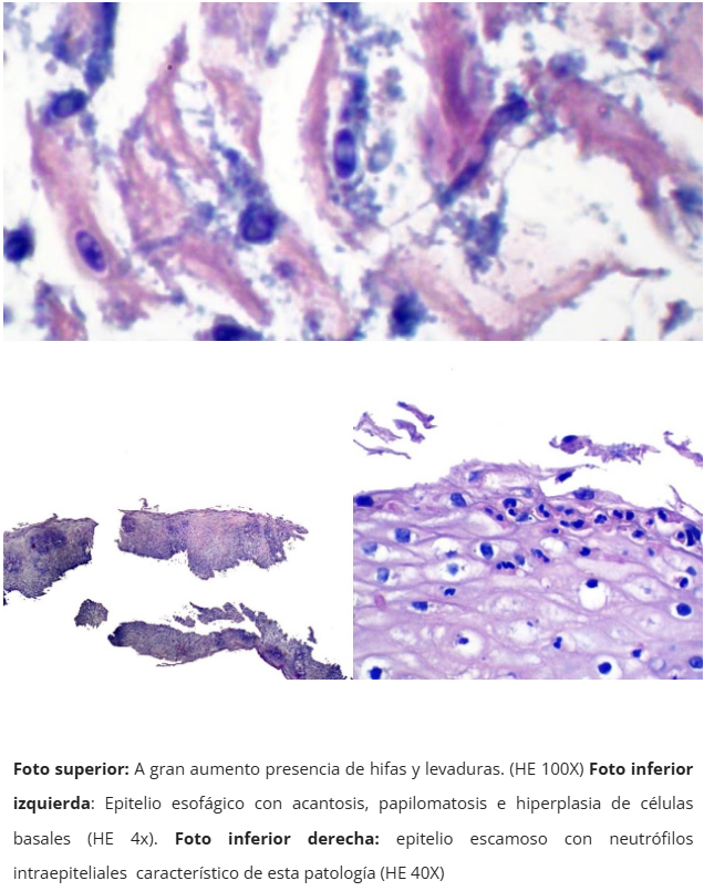 Esofagitis candidiásica