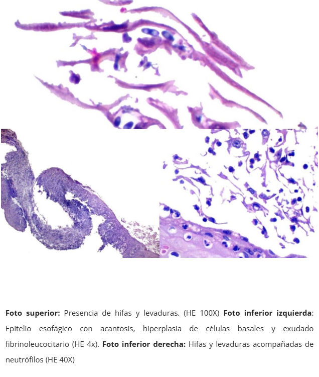 Esofagitis candidiásica