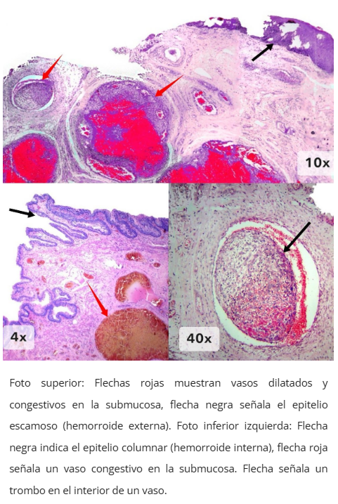 Imagen microscópica de hemorroides