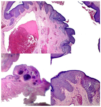 Imagen microscópica de hemorroides
