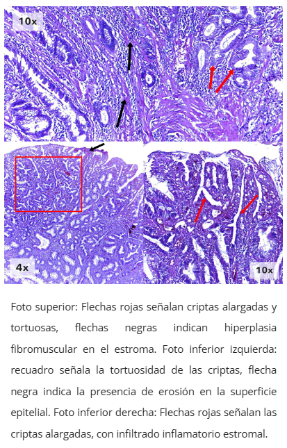 Imagen microscópica de pólipo cloacogénico