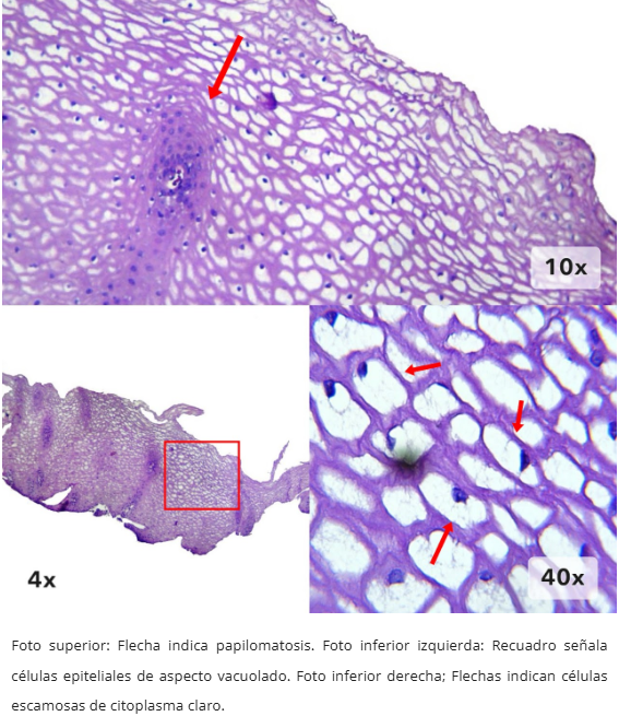 Acantosis Glicogénica