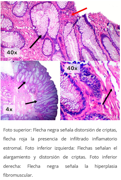 Imagen microscópica de pólipo cloacogénico