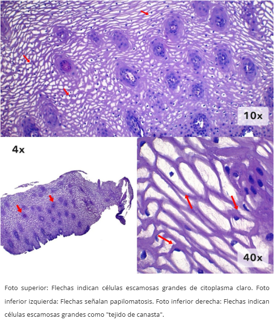 Acantosis Glicogénica