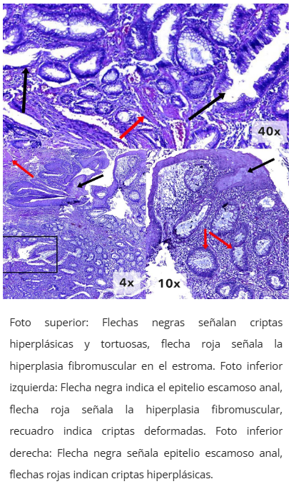 Imagen microscópica de pólipo cloacogénico