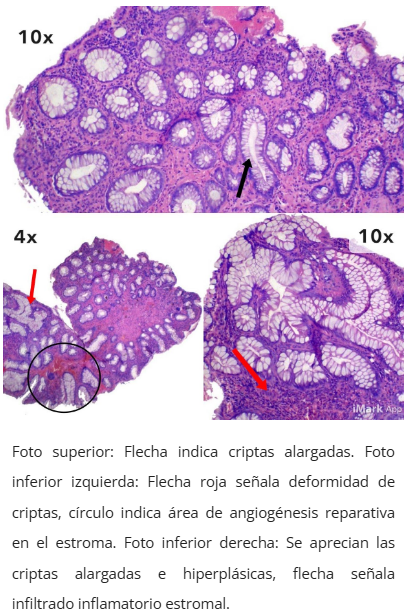 Imagen microscópica de pólipo cloacogénico