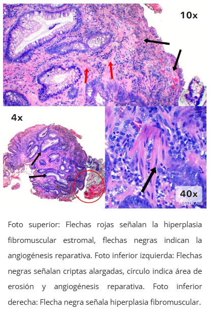 Imagen microscópica de pólipo cloacogénico
