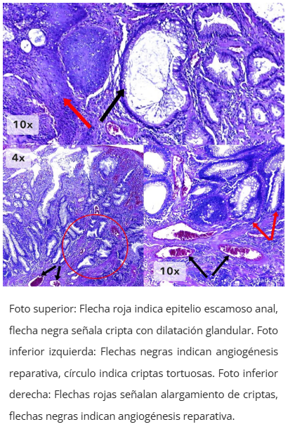 Imagen microscópica de pólipo cloacogénico