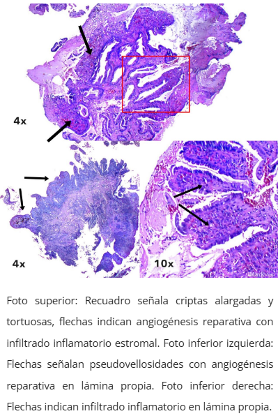 Imagen microscópica de pólipo cloacogénico