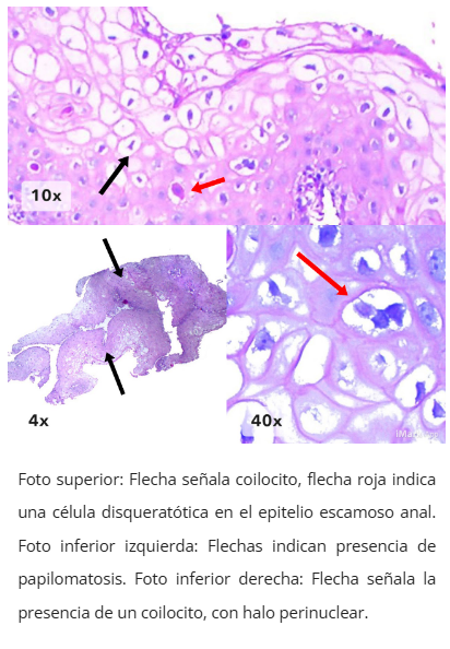 Imagen microscópica de condiloma anal