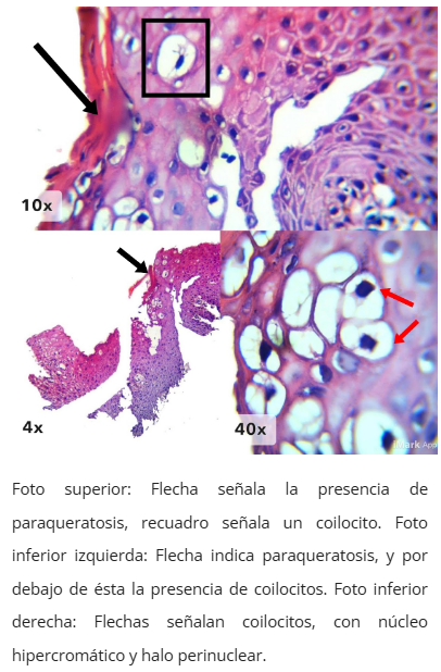 Imagen microscópica de condiloma anal