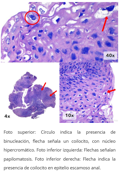 Imagen microscópica de condiloma anal