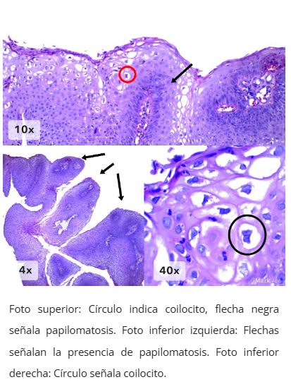 Imagen microscópica de condiloma anal