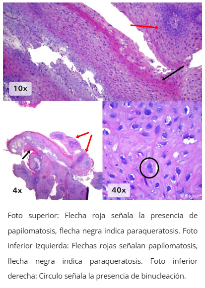 Imagen microscópica de condiloma anal