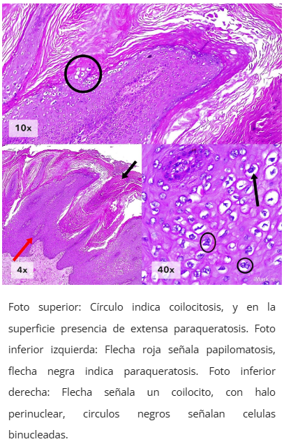 Imagen microscópica de condiloma anal