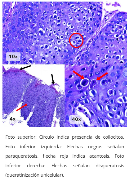Imagen microscópica de condiloma anal