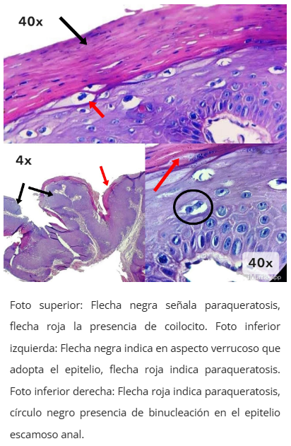 Imagen microscópica de condiloma anal