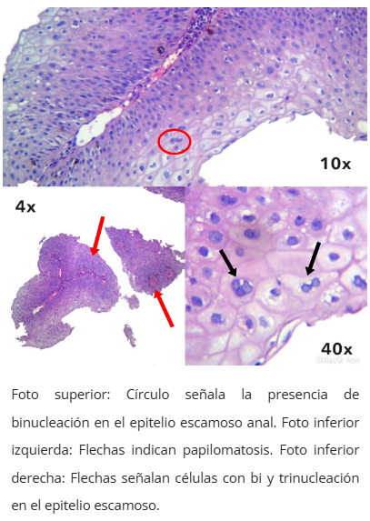 Imagen microscópica de condiloma anal