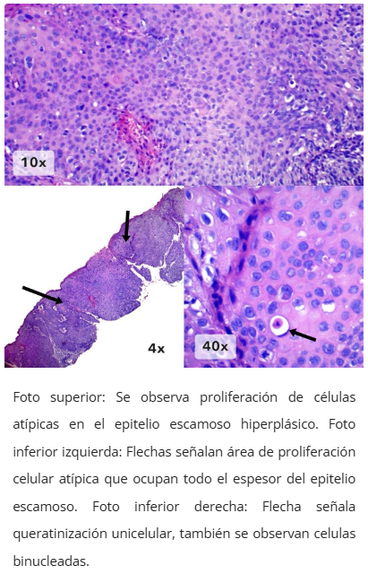 Imagen microscópica de neoplasia intraepitelial anal