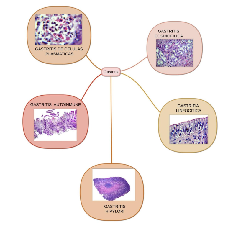 Microscopía de gastritis