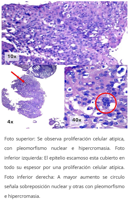 Imagen microscópica de neoplasia intraepitelial anal