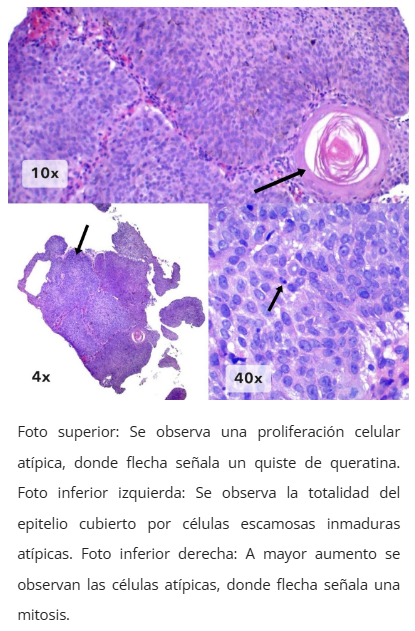 Imagen microscópica de neoplasia intraepitelial anal