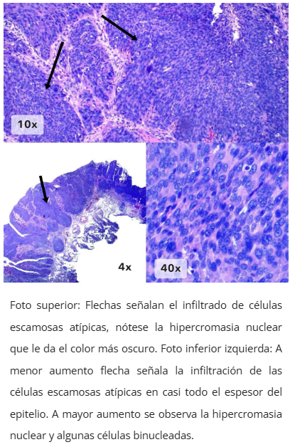 Imagen microscópica de neoplasia intraepitelial anal