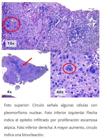 Imagen microscópica de neoplasia intraepitelial anal