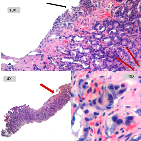 Gastritis Aguda Erosiva