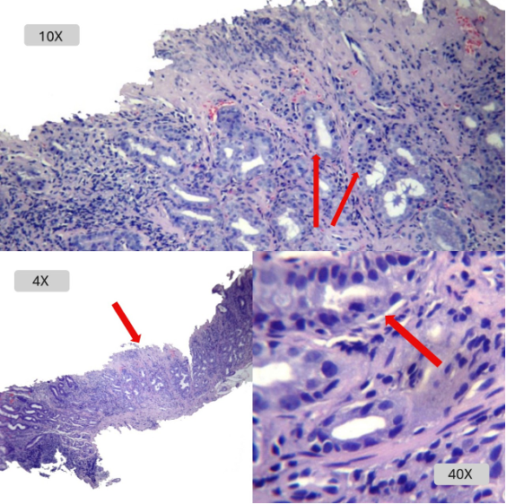 Gastritis Aguda Erosiva