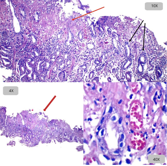 Gastritis Aguda Erosiva
