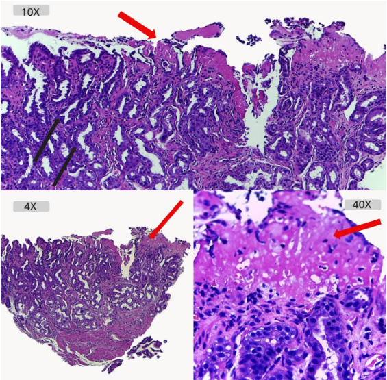 Gastritis Aguda Erosiva