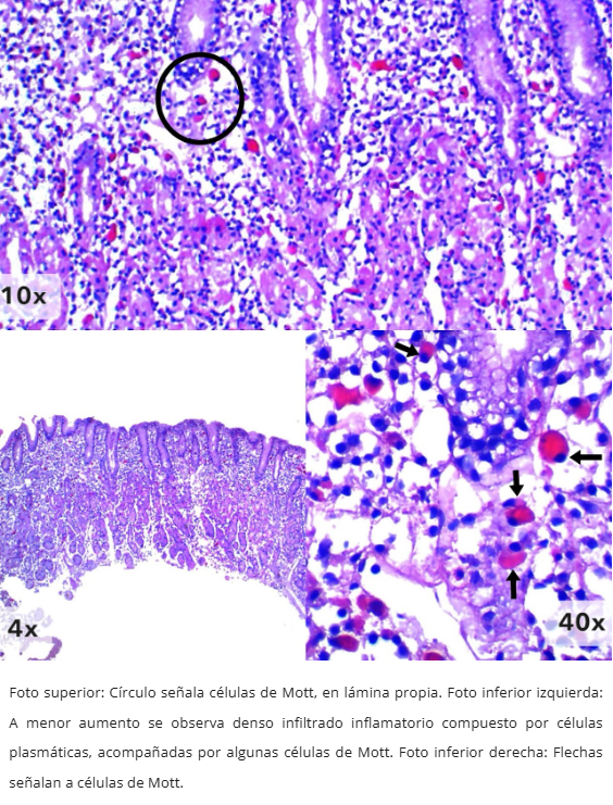 Gastritis de Células Plasmáticas